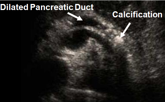 Chapter 9 : Pancreas: Abnormal